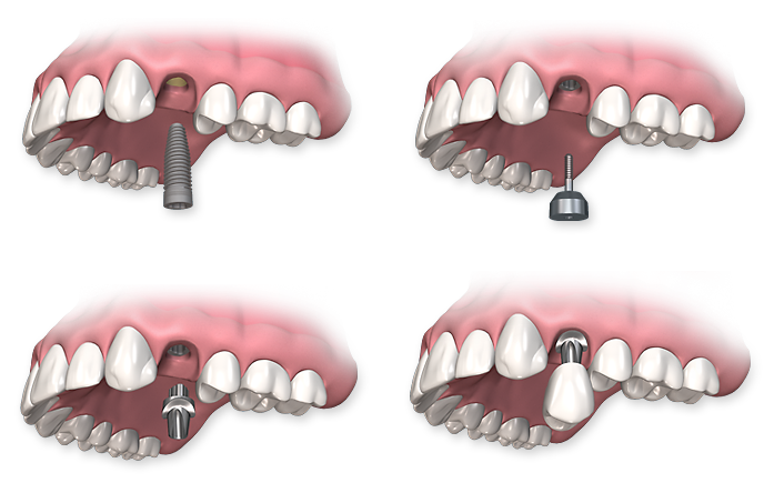 dental-implant