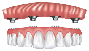 denture implants