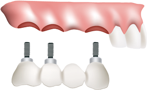 implant-bridge1